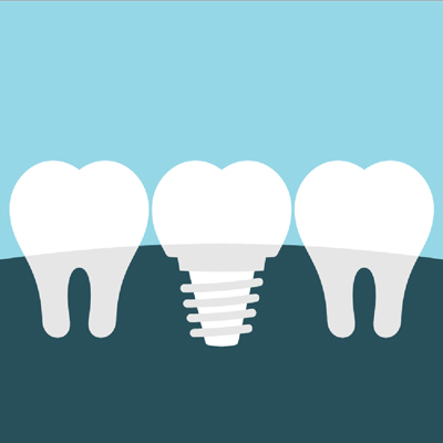 Illustration of dental implant