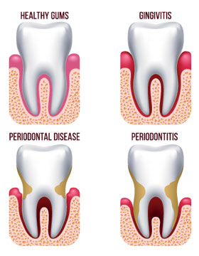 Illustration of the stages of gum disease