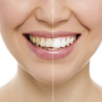 Before and after teeth whitening